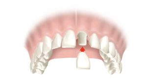 Що таке коронки на зуби?